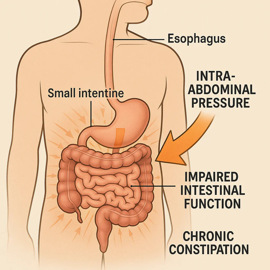Understanding Intra Abdominal Pressure in Chronic Constipation